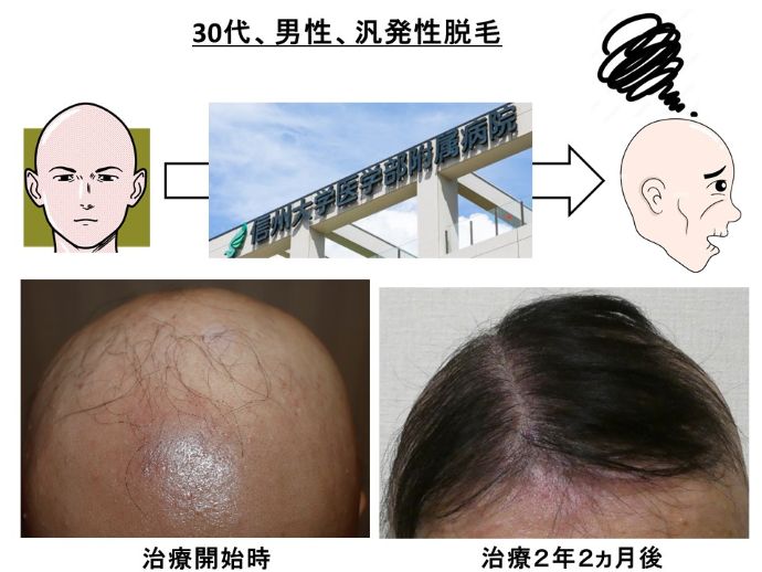 円形脱毛症　病院
